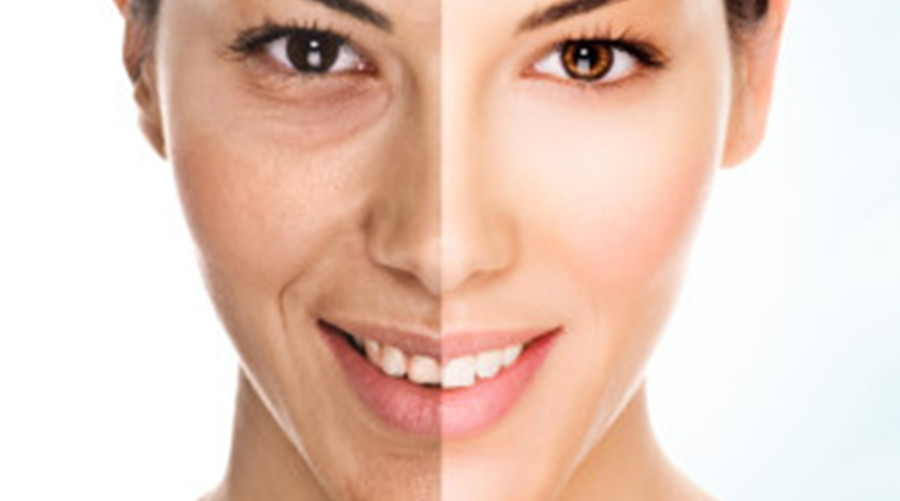 Fractora Advanced RF MicroNeedling