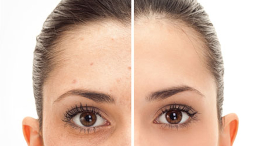 Laser Pigment Correction